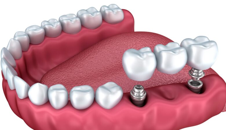 3 απλές συμβουλές για τη μετάβαση σε οδοντοστοιχίες εμφυτευμάτων