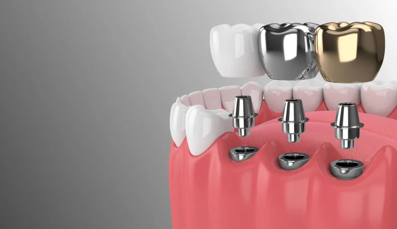 6 λόγοι για να αντικαταστήσετε τα δόντια που λείπουν