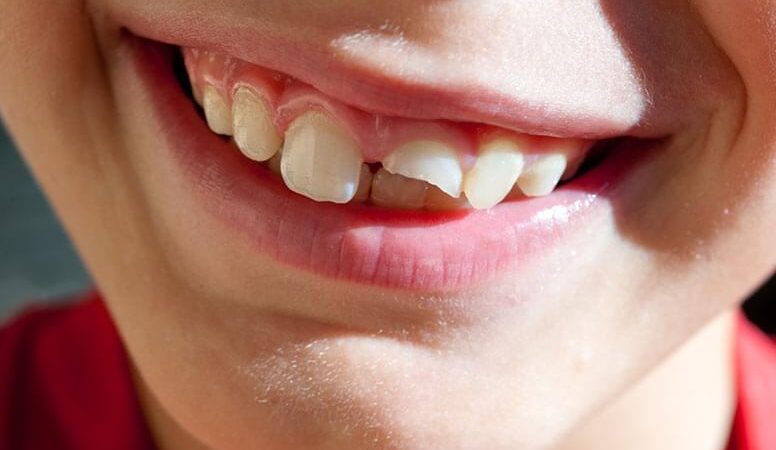 Η εξαγωγή δοντιών διορθώνει την ασθένεια των ούλων;
