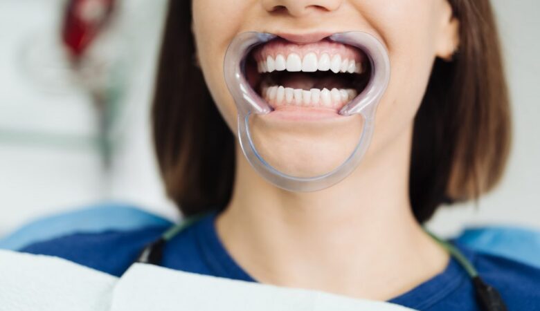 Οδοντικές κορώνες εναντίον καπλαμάδων: Ποιο είναι το καλύτερο για εσάς;