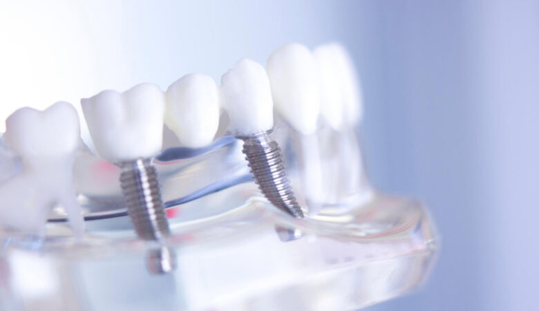 Περιμένατε πολύ καιρό για οδοντικά εμφυτεύματα;
