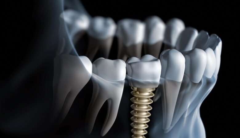 Ποια είναι τα στάδια των οδοντικών εμφυτευμάτων;