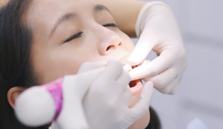 Πώς να παρατείνετε τη διάρκεια ζωής των οδοντικών όψεων