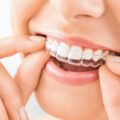 Συγκόλληση δοντιών: Τι να περιμένετε εάν έχετε κολλήσει τα δόντια σας