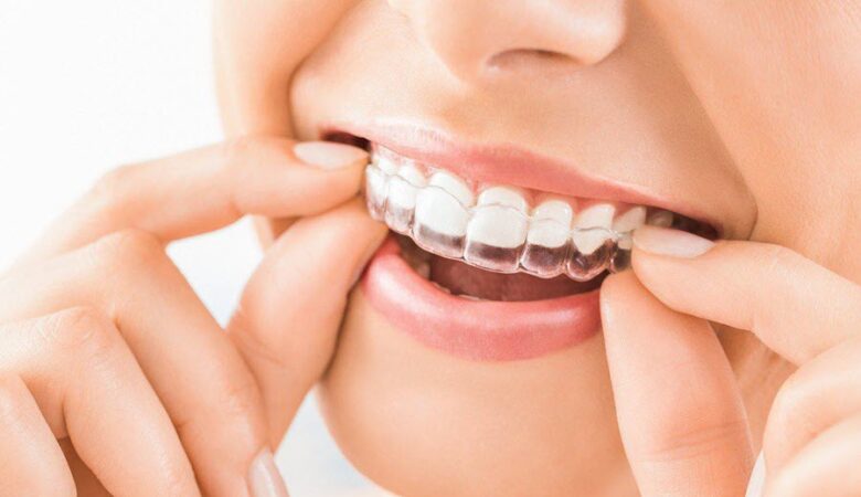 Συγκόλληση δοντιών: Τι να περιμένετε εάν έχετε κολλήσει τα δόντια σας